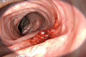 What Is Colorectal Cancer?