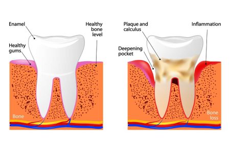 Normal teeth VS periodontitis