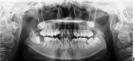 Panoramic x-ray of crowding teeth
