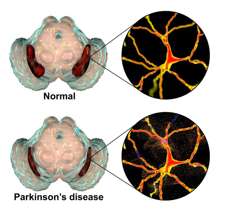 Normal vs damaged substantia nigra