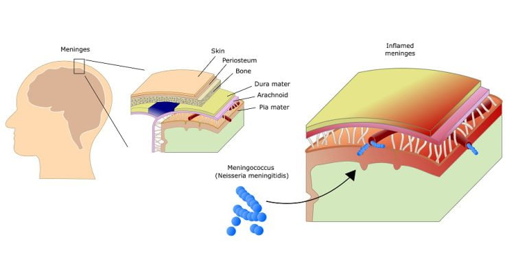 Effect of meningitis