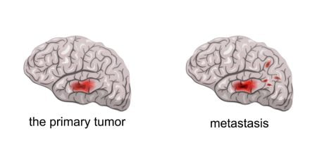 Brain cancer and metastasis