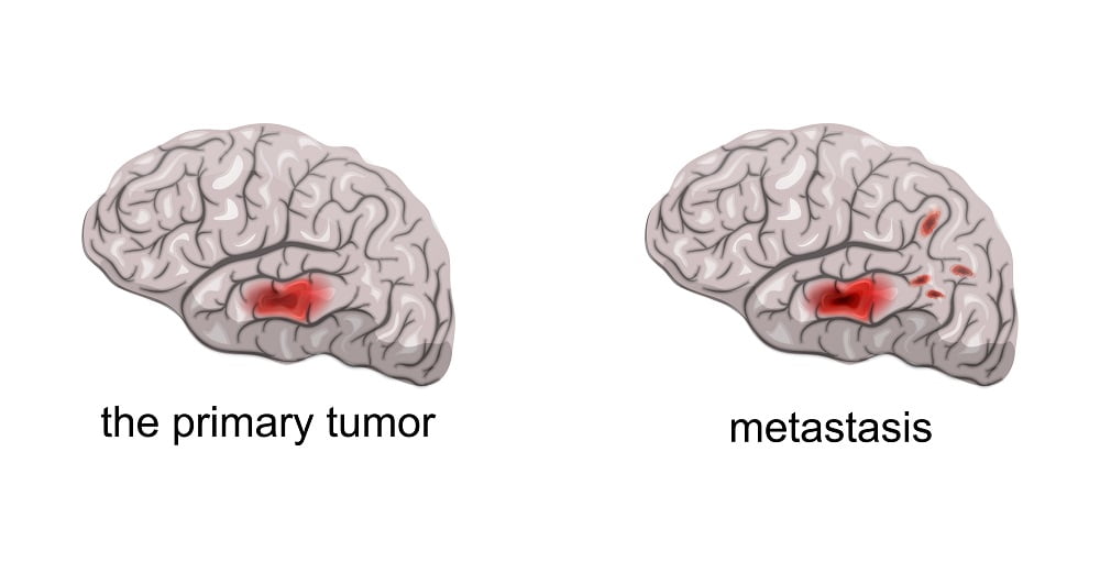 Brain cancer and metastasis