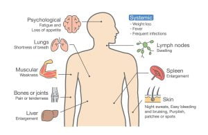 Leukemia symptoms