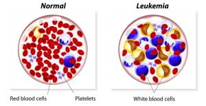 Normal vs leukemia blood cells