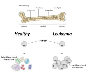 Leukemia - Bone marrow