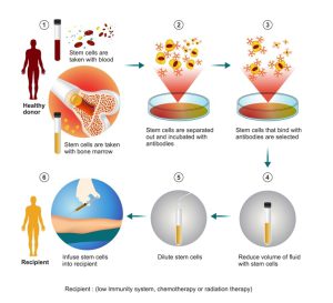 Allogeneic bone marrow transplant