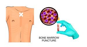 Diagnosis of leukemia