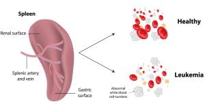 Effects of leukemia