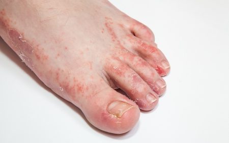 Dermatitis on foot