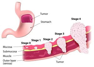 Stages of stomach cancer