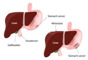 Stomach cancer metastasized to the liver