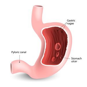 Peptic ulcer disease