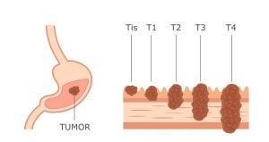 Stomach cancer stages