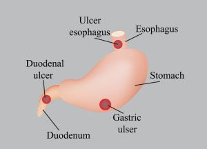 Location of ulcers