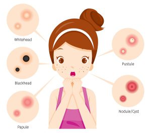 Types of acne