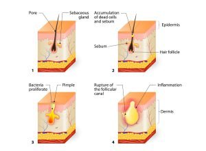 Acne formation