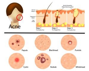 Different types of acne