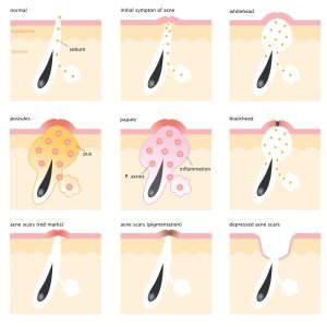 Formation of skin acne