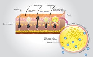 Acne vulgaris