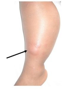 Tuberculosis leg swelling (lump)