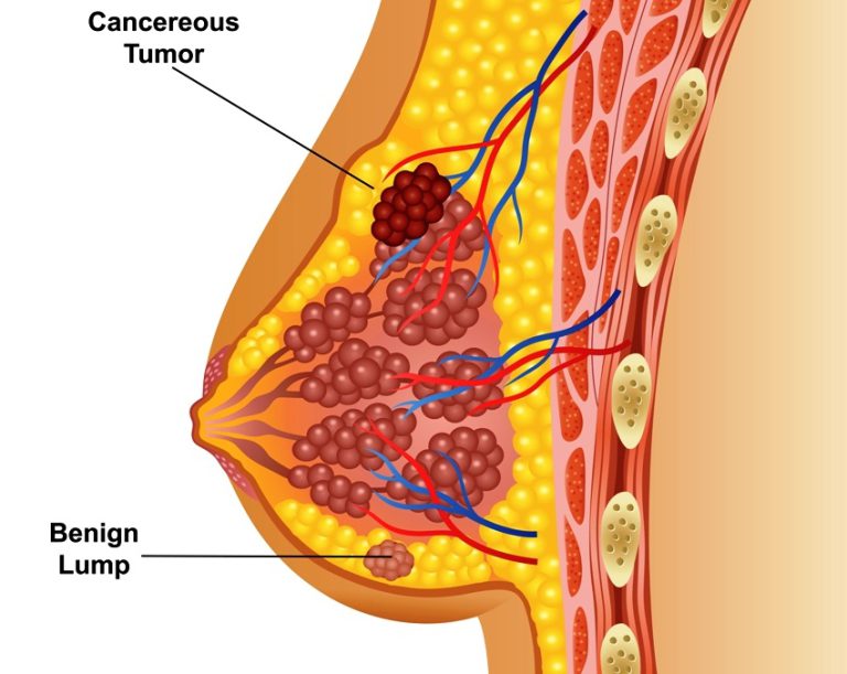 Breast Cancer Lumps