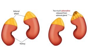 What is neuroblastoma?