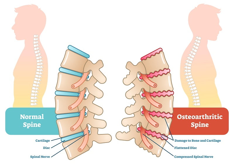 Osteoarthritis and pinched nerve