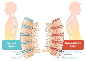 Spinal arthritis and stenosis