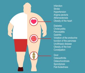 Obesity and back problems