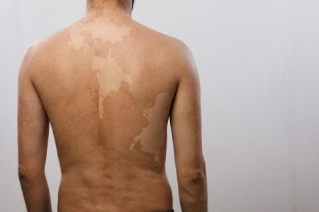 Vitiligo on back