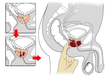 Physical examination for prostatitis (digital rectal exam)