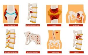 Spine diseases