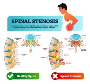 Healthy spine vs spinal stenosis