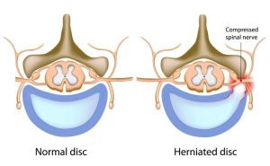 Spinal stenosis due to herniated disc