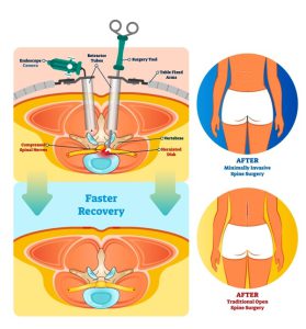 Minimally invasive spine surgery for spinal stenosis