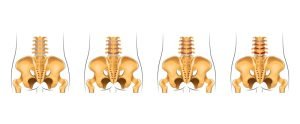 Ankylosing spondylitis