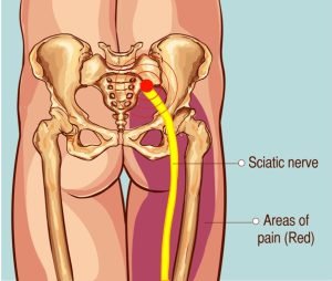 Sciatic nerve and pain locations