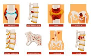 Common spine diseases