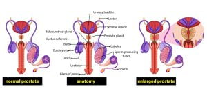 Male healthy prostate compared to an enlarged prostate