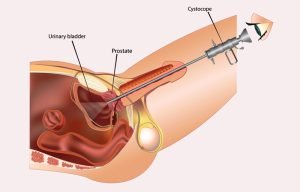 Cystoscopy