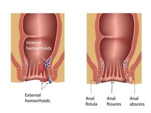 Anal lumps can be a sign of hemorrhoid