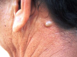 Skin lumps: Lipomas