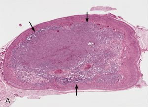 Incidental in situ neuroblastoma