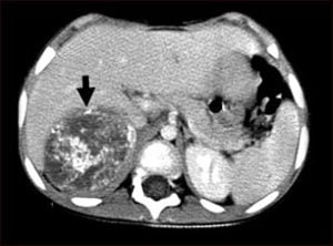 Neuroblastoma in the liver