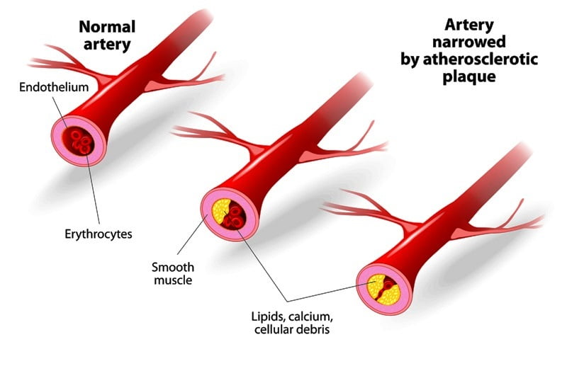 Atherosclerosis