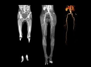 CT Scan imaging showing 2D and 3D rendering image of lower Extremity