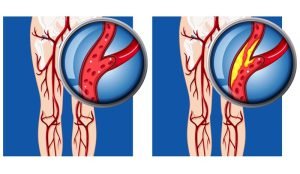 Peripheral arterial disease in lower limb