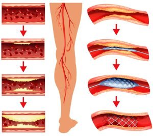 Diagram showing angioplasty for peripheral artery disease