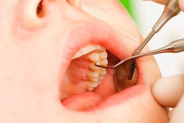diagnosis of dental caries